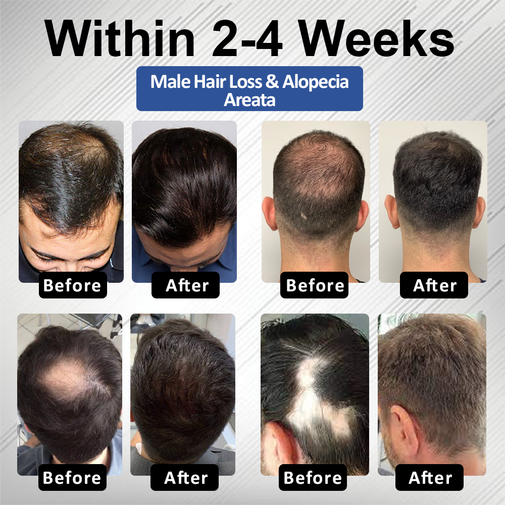 🔥FDA-Reviewed. Visible in 7 Days. Guaranteed-DarkFairy® PP405 FolliGen Re-Awaken Hair Spray